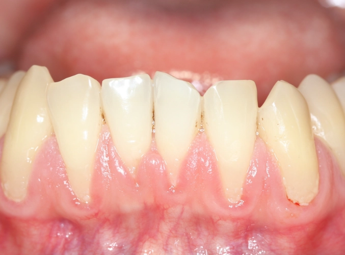 receding gums sensitive to cold