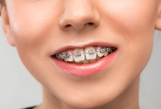 Speed Up Braces Treatment: Proven Methods to Shorten Orthodontic Time