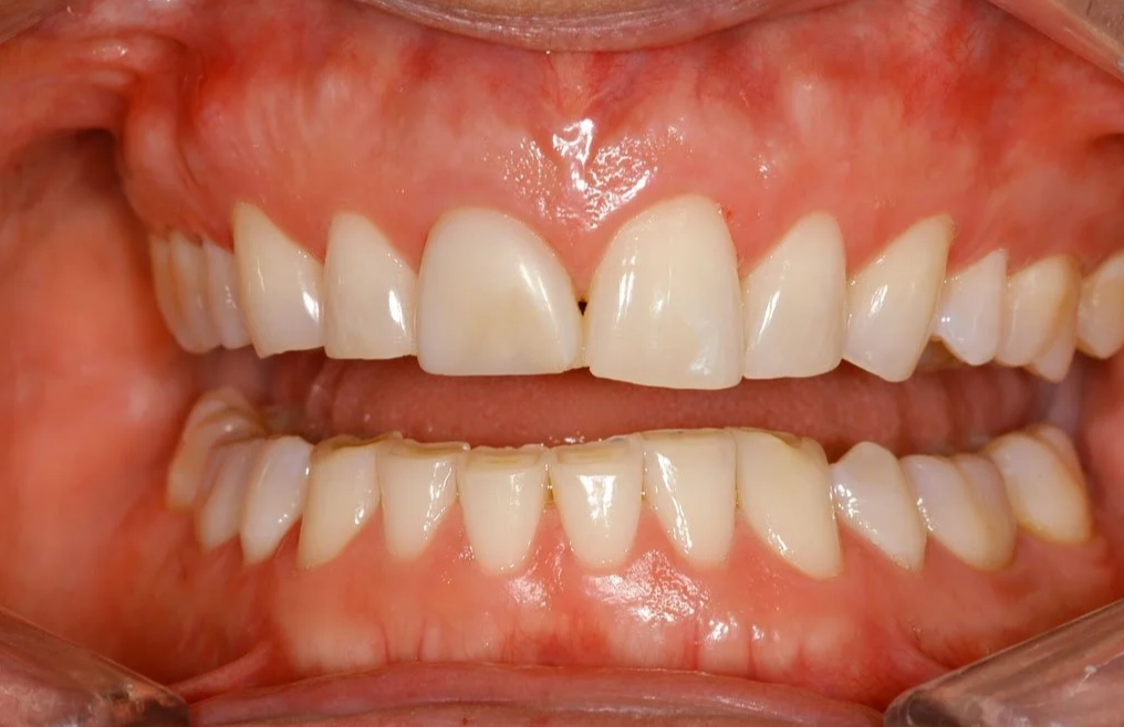 night guard for teeth grinding