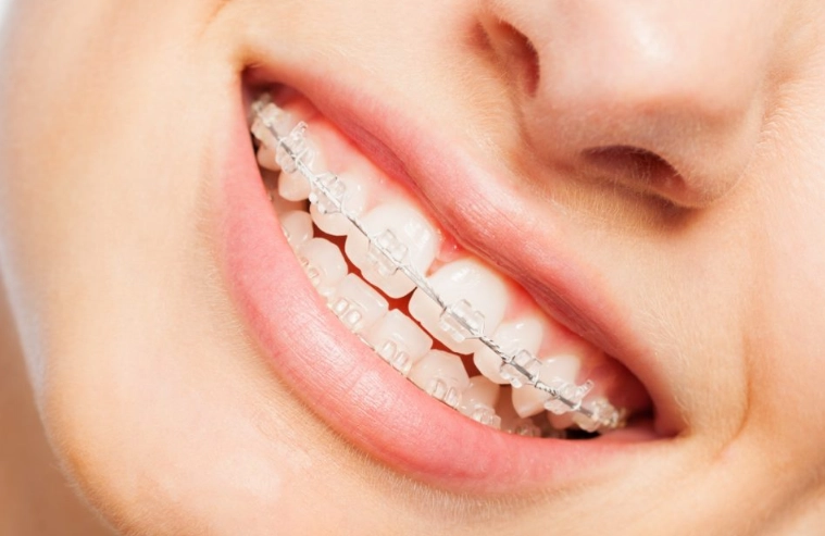 accelerate orthodontics