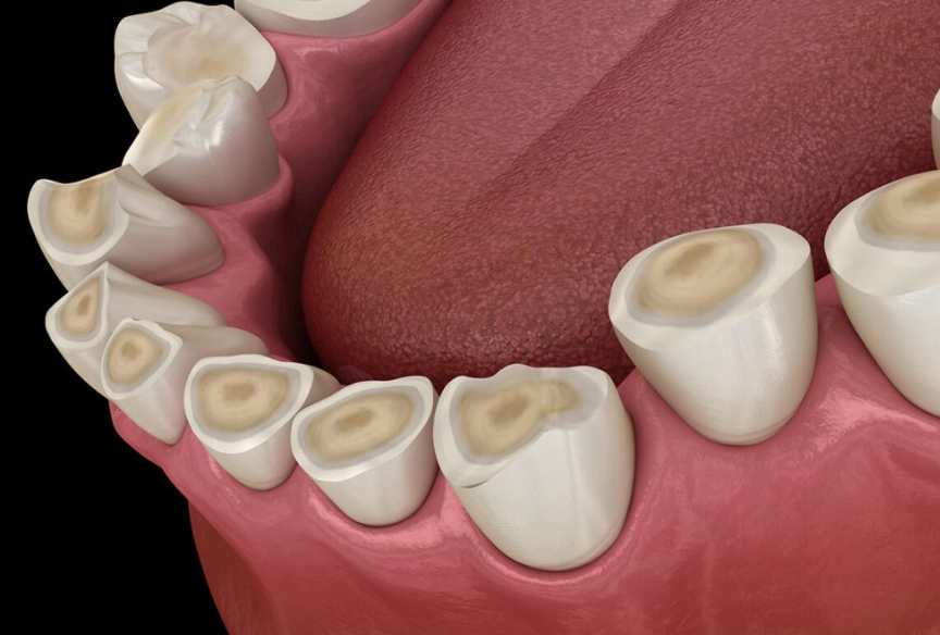 teeth grinding damage