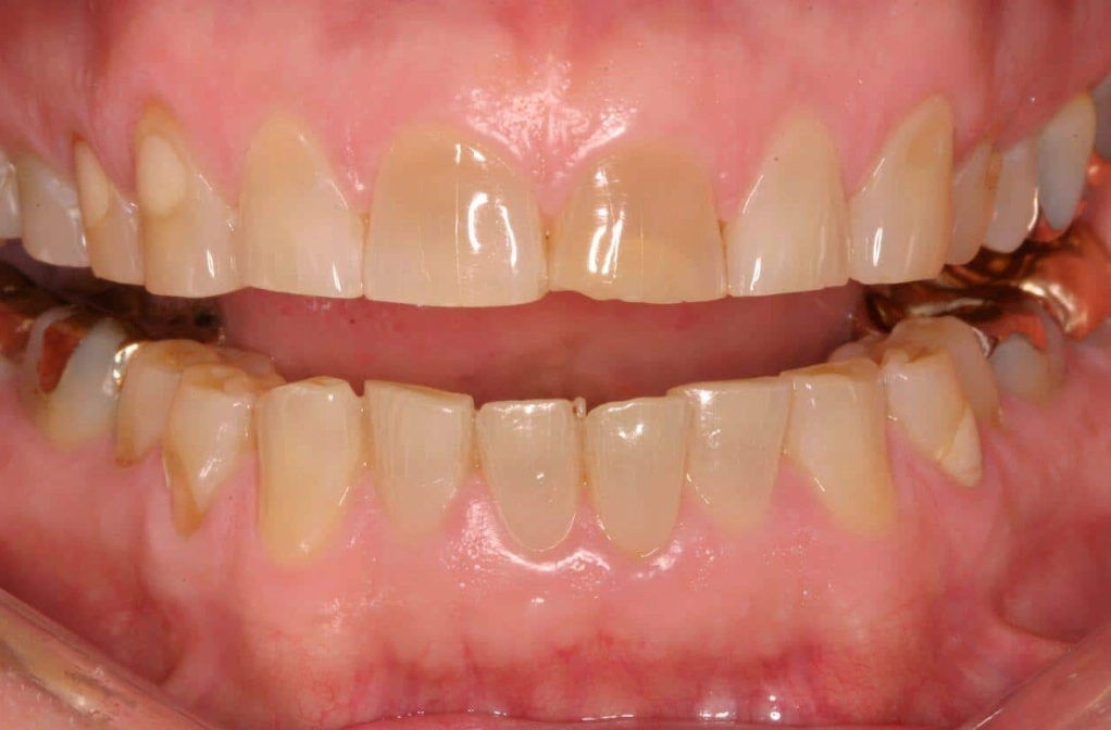 how to stop grinding teeth