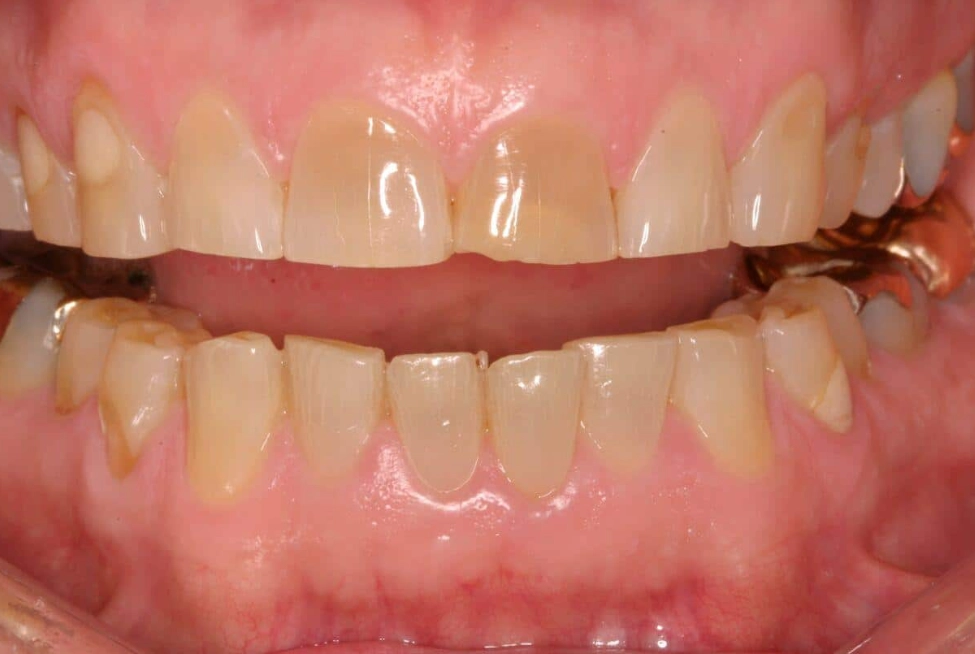 sleep bruxism sleep bruxism