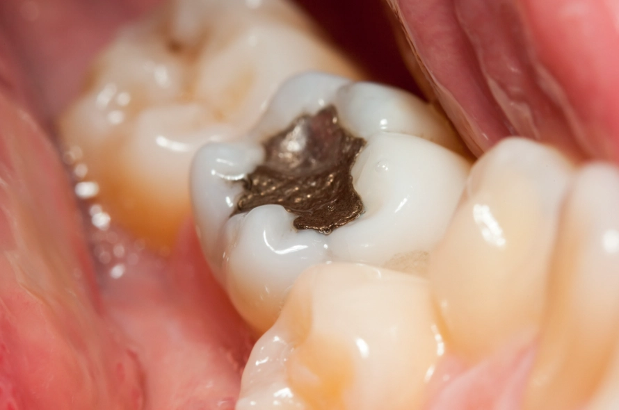 composite vs amalgam fillings