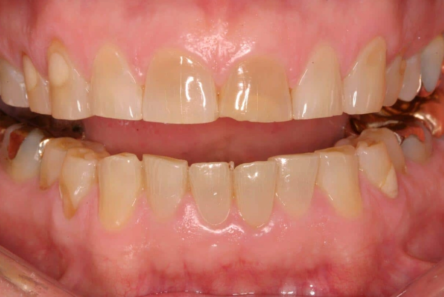 sleep bruxism treatment