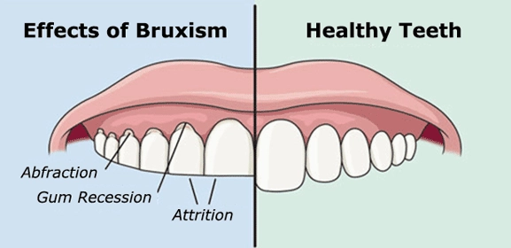 night guard alternatives night guard alternatives