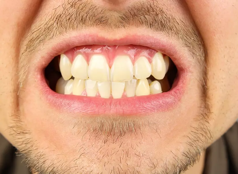 how to stop grinding teeth how to stop grinding teeth