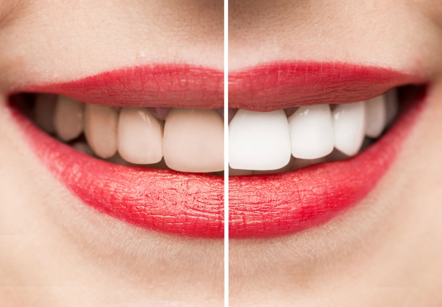 how to whiten teeth