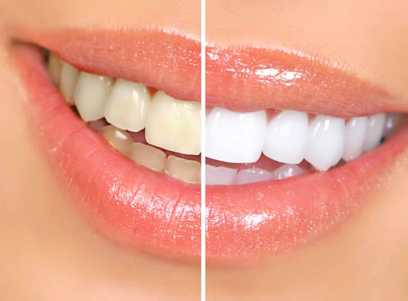 how to whiten teeth