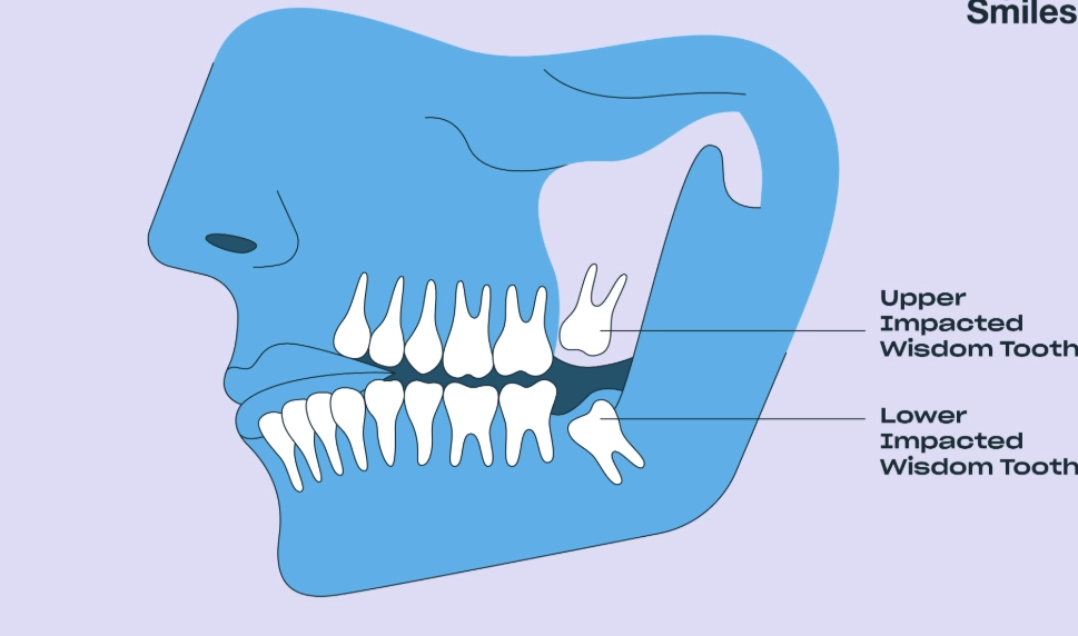 wisdom teeth removal timing wisdom teeth removal timing