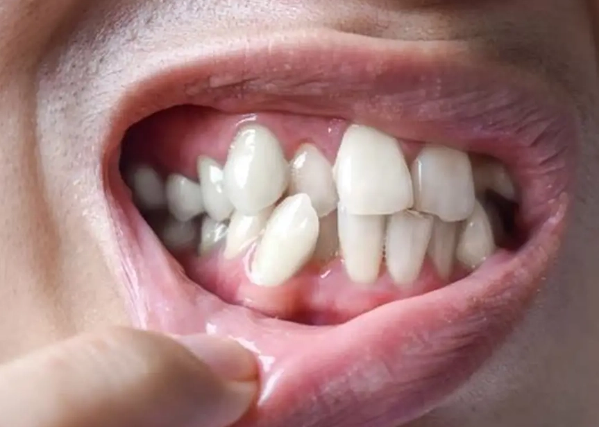 wisdom teeth crowding other teeth
