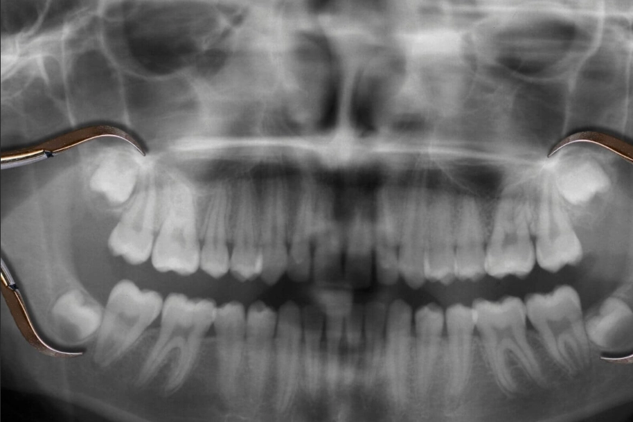 Wisdom Tooth Extraction Side Effects: Recovery Guide and Management Tips