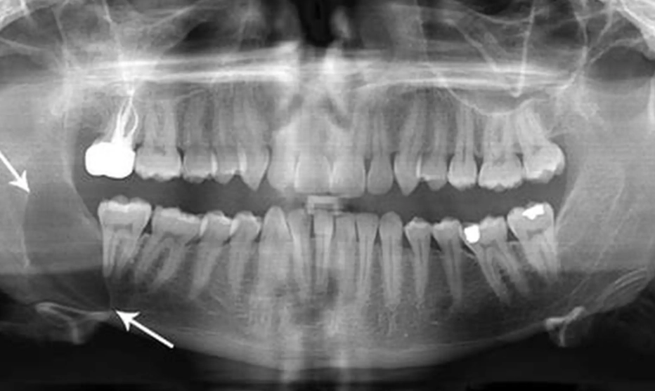dentigerous cyst treatment dentigerous cyst treatment
