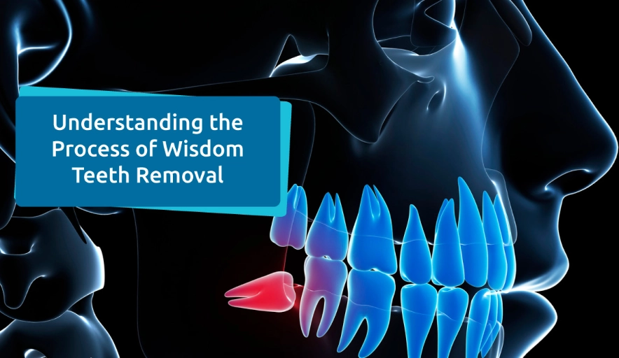wisdom tooth removal recovery