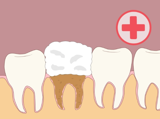 Dry Socket Prevention: A Complete Guide to Avoid Pain After Tooth Extraction