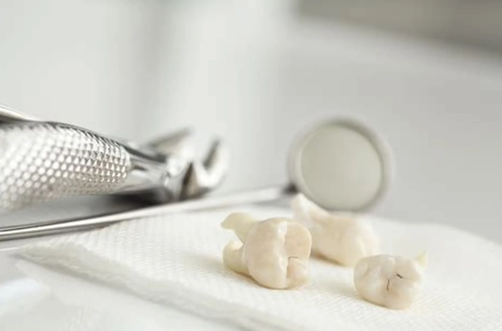 Wisdom Teeth Removal Age: The Complete Guide for Adults