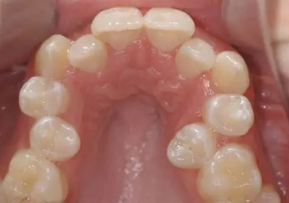 Wisdom Teeth and Crowding: The Real Link, Treatment Options & Myths