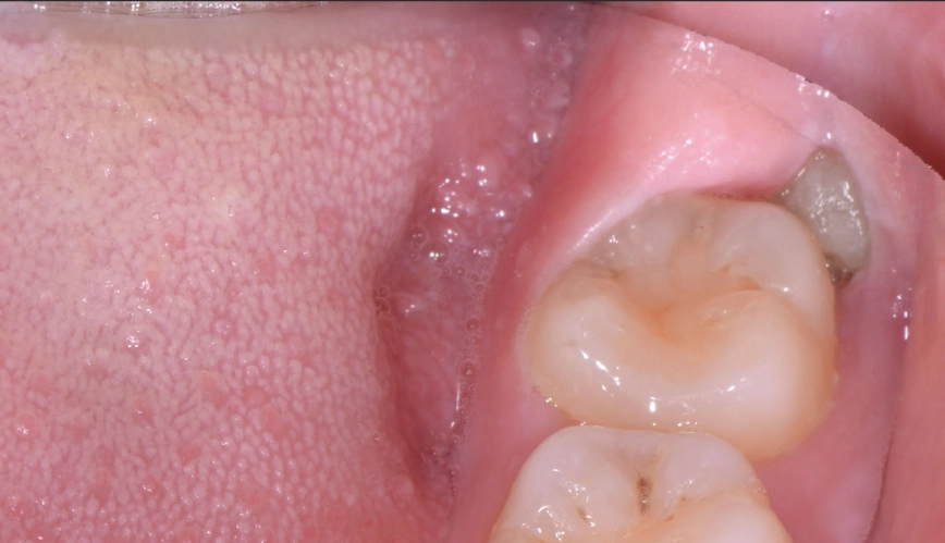 impacted wisdom tooth symptoms impacted wisdom tooth symptoms