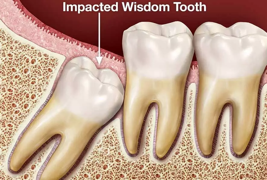 wisdom tooth removal recovery