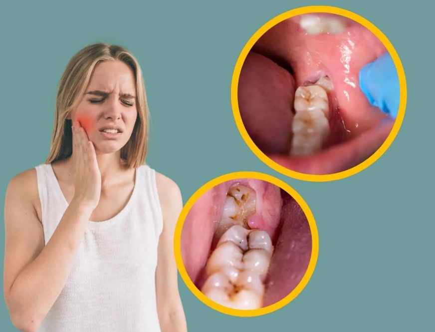 impacted wisdom tooth cyst impacted wisdom tooth cyst