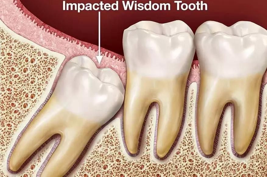 impacted wisdom teeth symptoms impacted wisdom teeth symptoms