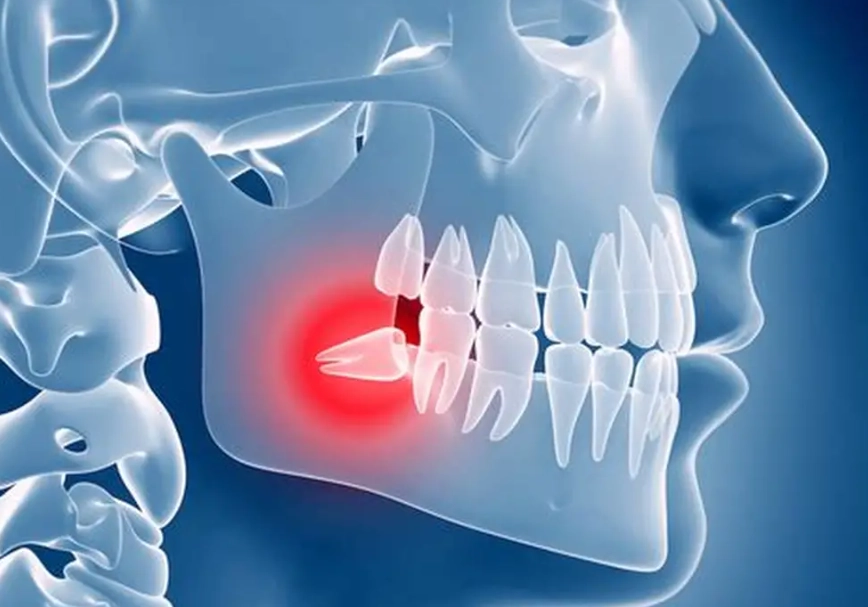 wisdom tooth home remedies wisdom tooth home remedies