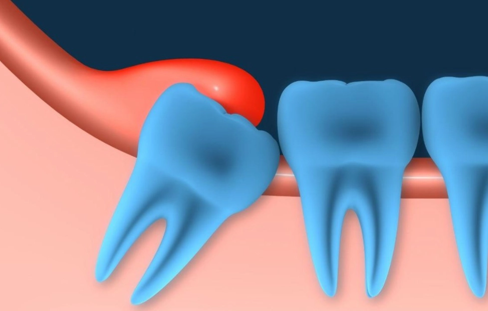 impacted wisdom tooth
