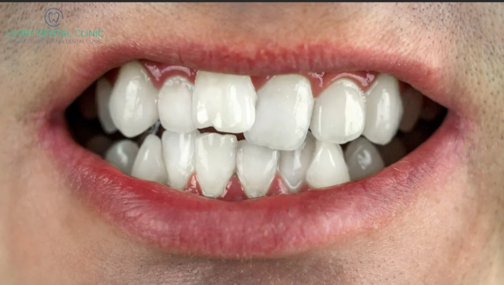 wisdom teeth crowding other teeth wisdom teeth crowding other teeth