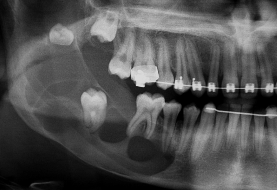 wisdom tooth cyst symptoms