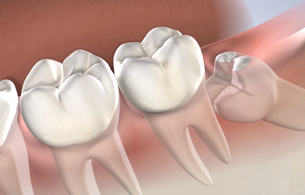 impacted wisdom teeth impacted wisdom teeth