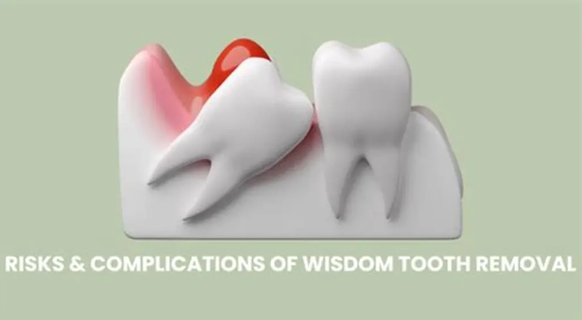 impacted wisdom tooth cyst impacted wisdom tooth cyst