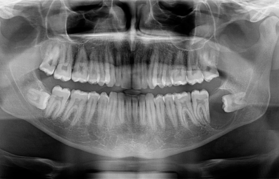 wisdom tooth cyst symptoms wisdom tooth cyst symptoms