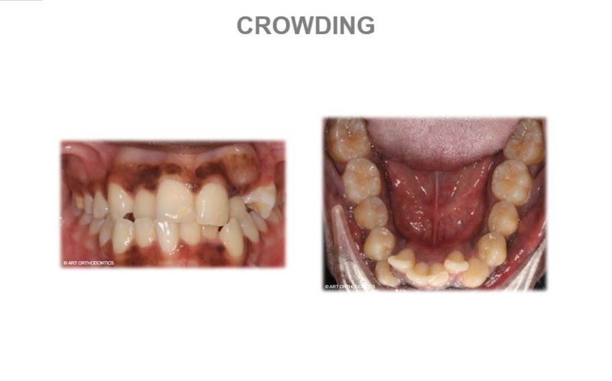 do wisdom teeth cause crowding do wisdom teeth cause crowding