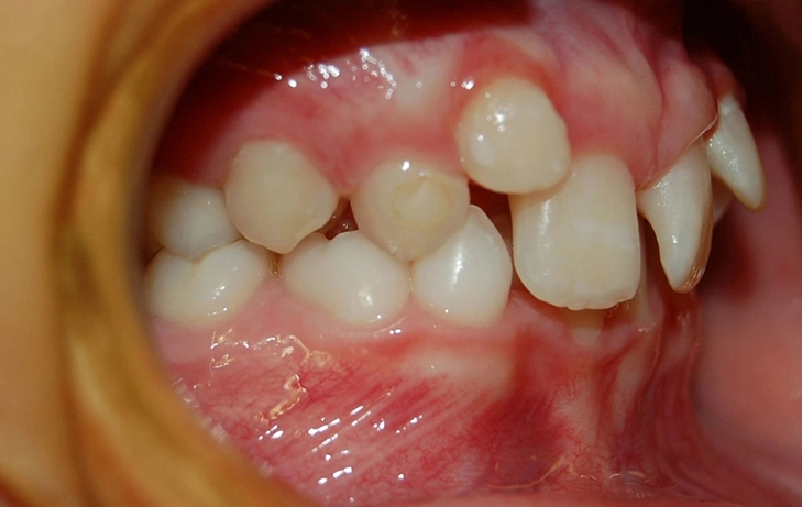 do wisdom teeth cause crowding do wisdom teeth cause crowding
