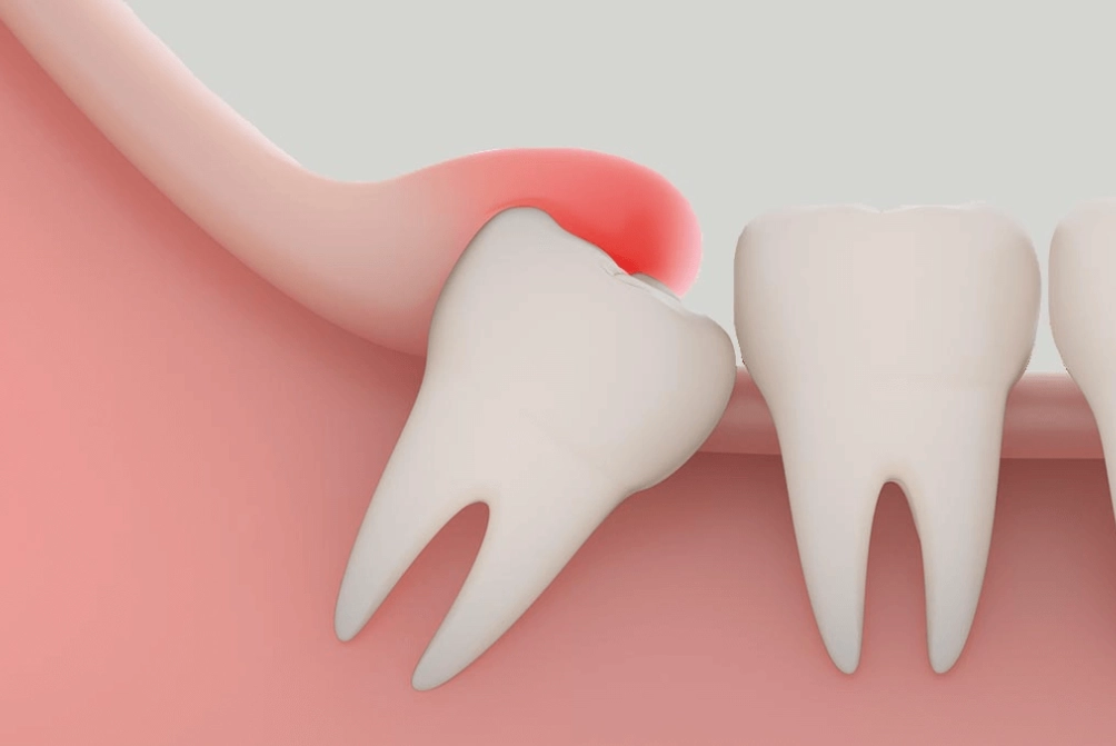 Wisdom Tooth Infection: Symptoms, Treatment, and How to Prevent It