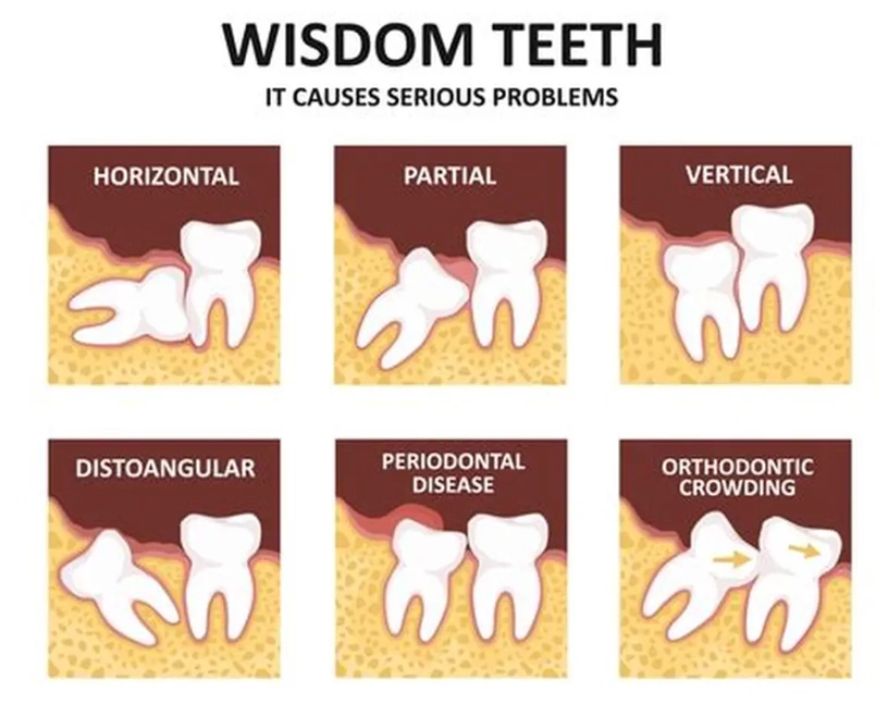 wisdom tooth pain relief wisdom tooth pain relief
