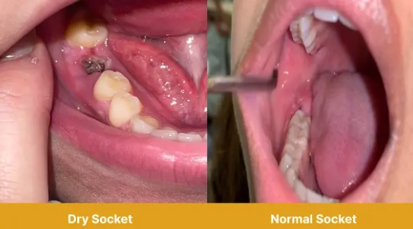 dry socket prevention tips