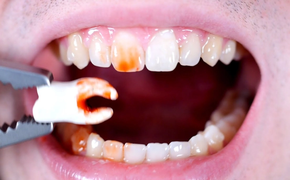 tooth extraction tooth extraction