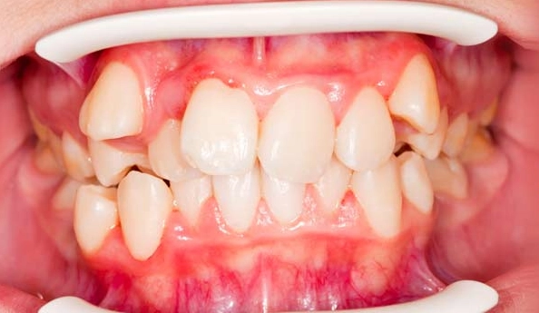 benefits of oil pulling benefits of oil pulling