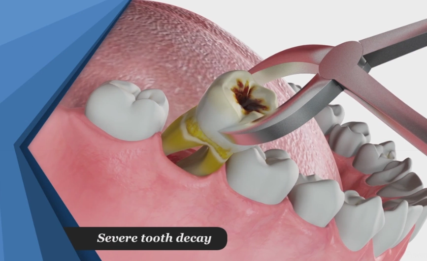 Teeth Pulled Out: The Complete Guide to Tooth Extraction and Recovery