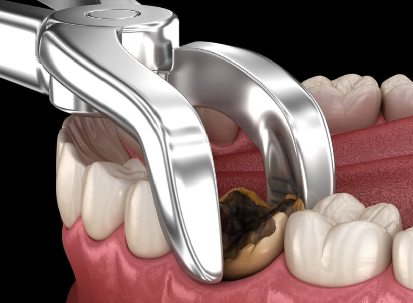 pulled tooth recovery pulled tooth recovery