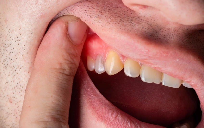 oral ulcer root canal