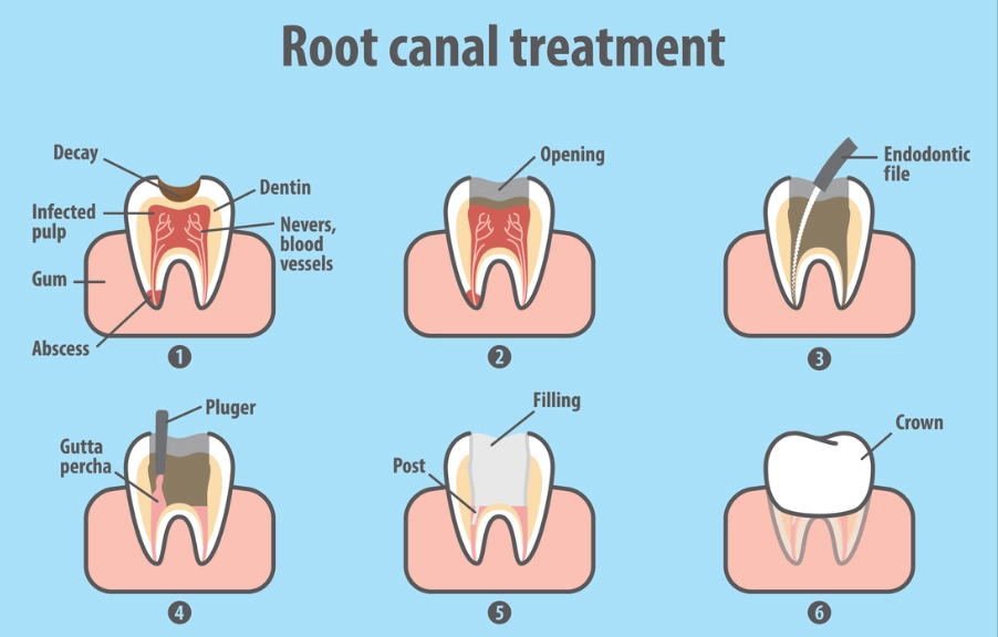 tooth discoloration after root canal tooth discoloration after root canal