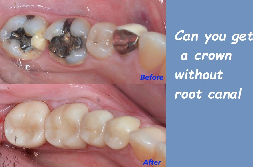 tooth after root canal tooth after root canal