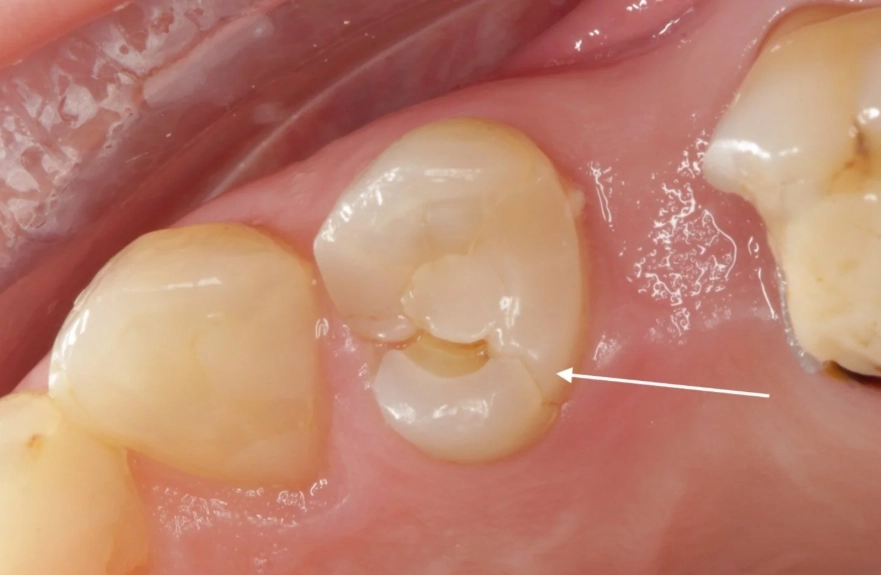 dental crown necessity dental crown necessity