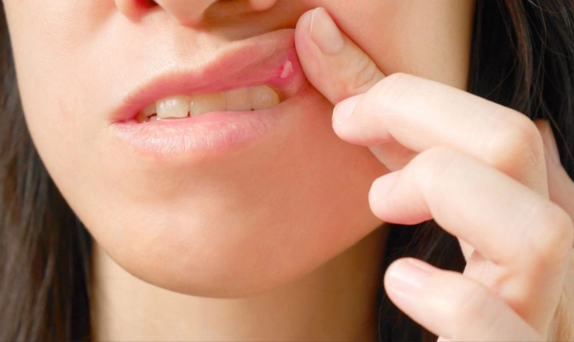 canker sore after dental work