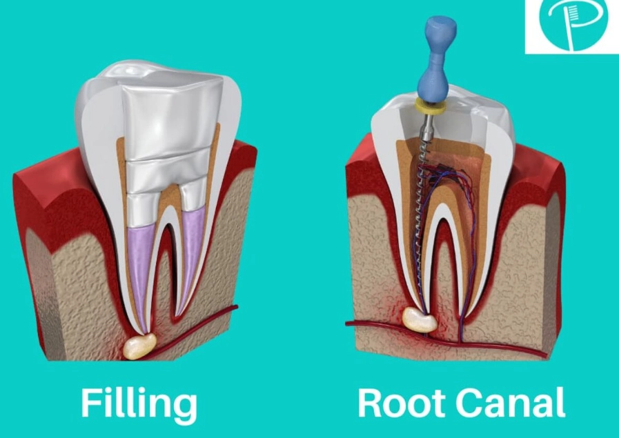 root canal crown color root canal crown color
