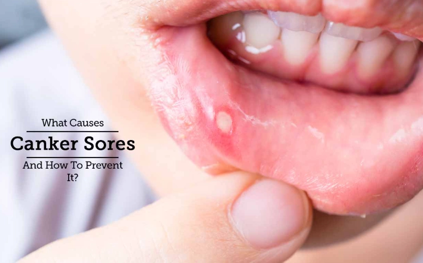 Can a root canal cause canker sores?