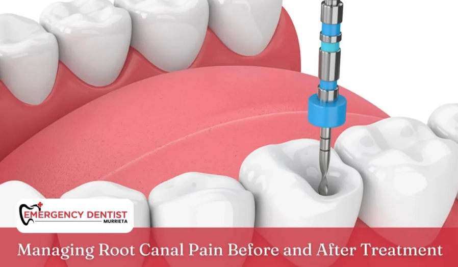 How painful is it after a root canal?