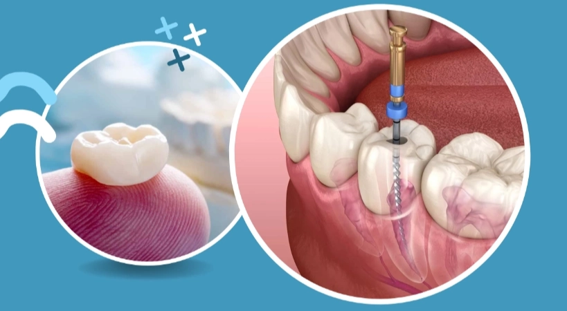 dental crown necessity